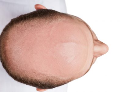 Biotin Eksikliği