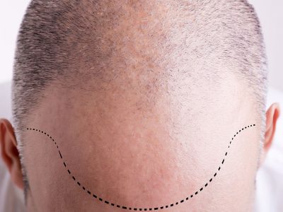 Saç Çizgisinin Oluşturulması