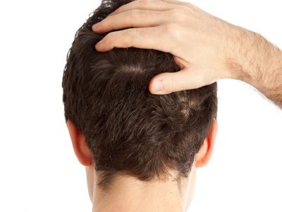 Saç Ekiminden Sonra İlk Hafta