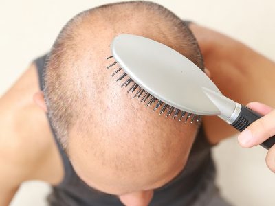 Erkek tipi saç dökülmesi başın tepe bölgelerinde ve ön saç çizgisinde seyrelme ile görülür.