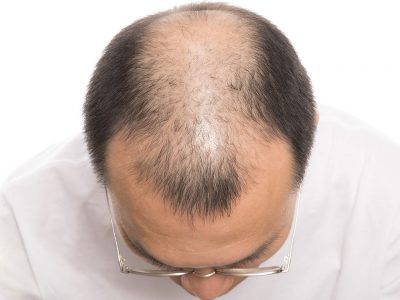 Erkek Tipi Saç Dökülmesinin Tedavisi