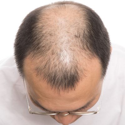 Erkek Tipi Saç Dökülmesinin Tedavisi