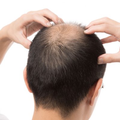 Erkek Tipi Saç Dökülmesinin nedenleri