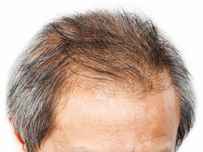 Erkeklerde Saç Dökülmesi Sonrası Saç Ekim