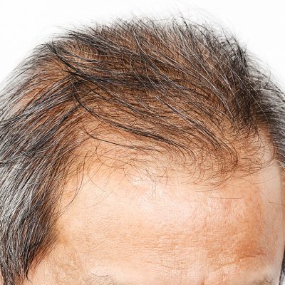 Erkeklerde Saç Dökülmesi Sonrası Saç Ekim