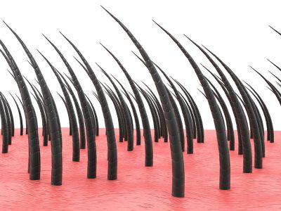 Fue tekniği ile ense ve yanlardan alınan saç kökleri kullanılır. 