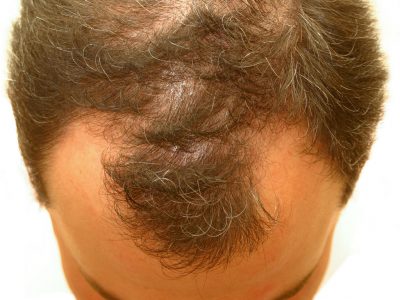 Geçici Saç Dökülmesi