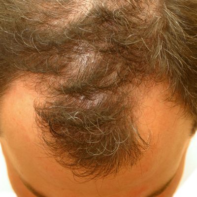 Geçici Saç Dökülmesi