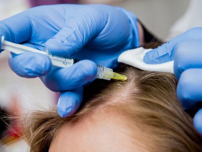 Kadınlarda saç ekimi aşamalarında analiz yapılarak başlanır. 