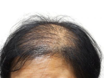 Kemoterapiye Bağlı Saç Dökülmesinin Tedavisi