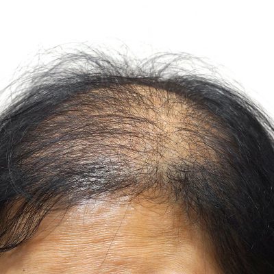 Kemoterapiye Bağlı Saç Dökülmesinin Tedavisi