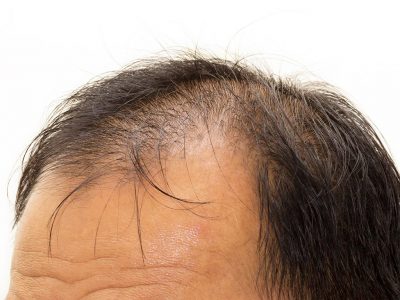 Kök Hücre Saç ekiminde Yenilik