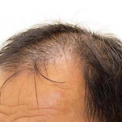 Kök Hücre Saç ekiminde Yenilik