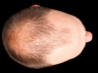 Mevsimsel Saç Dökülmesi