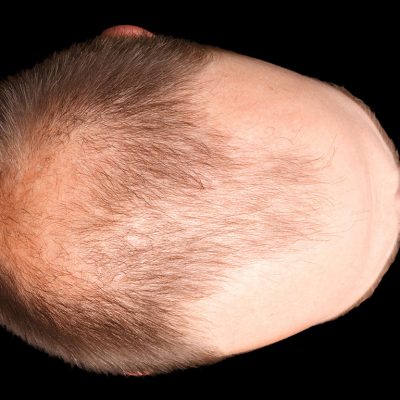 Mevsimsel Saç Dökülmesi