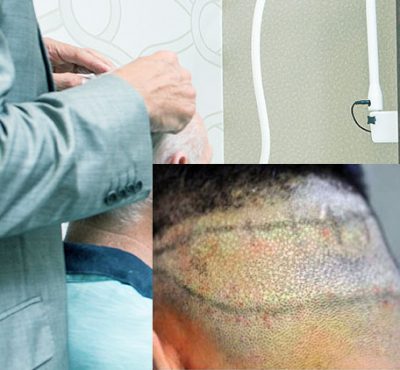 saç ekimi yöntemleri