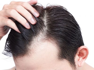 Saç çizgisinin belirlenmesi