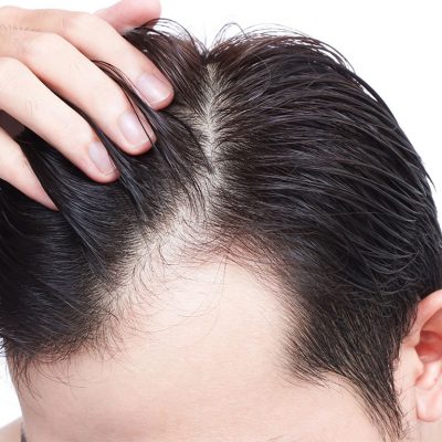 Saç çizgisinin belirlenmesi