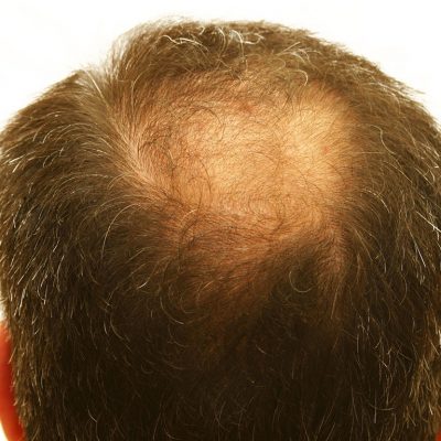 Saç Çizgisinin Eğriliği