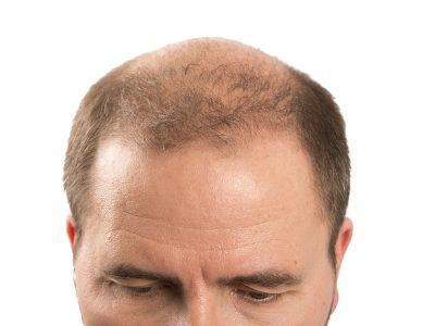 Saçlı Deri Kayıpları