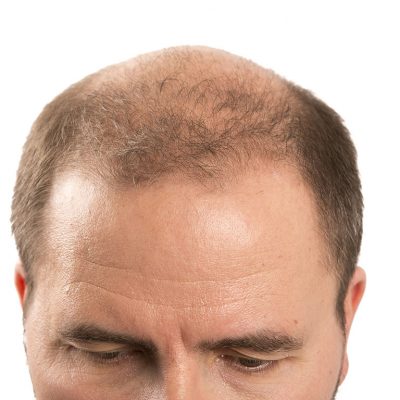 Saçlı Deri Kayıpları