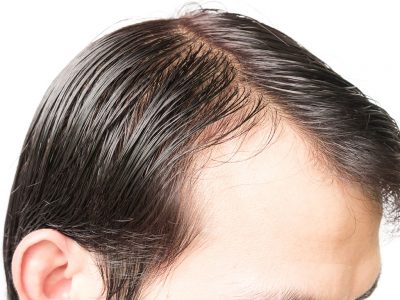 Saç ekim öncesi yapılacaklar