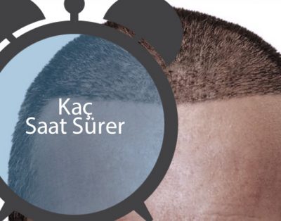 Saç ekimi kaç saat sürer