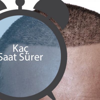Saç ekimi kaç saat sürer
