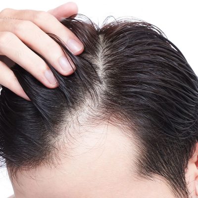 Saç ekimi sonrası çim adam görünümü