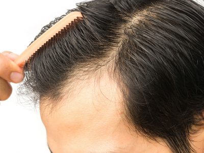 Saç Ekimi Yapılmış Alanının Travmadan Korunması