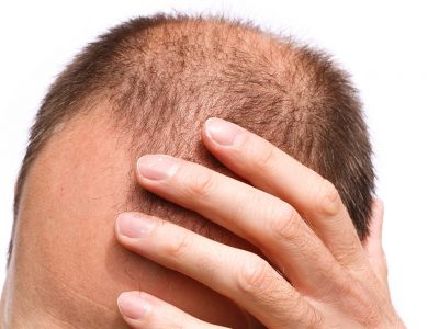 Saç Ekiminde Ağrı