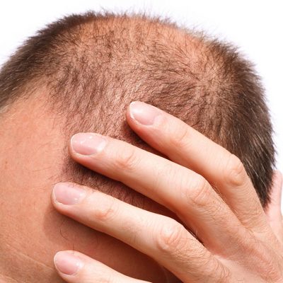 Saç Ekiminde Ağrı