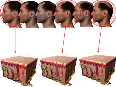 Saç ekiminde sıkça sorulan sorular