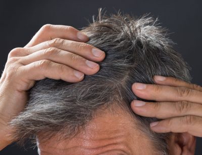 Saç ekimi sonrası şişlik