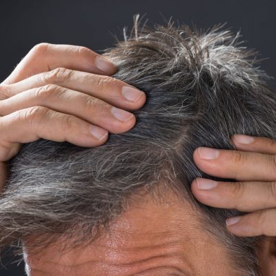 Saç ekimi sonrası şişlik