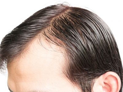 Saç Ekiminden Sonra İstenmeyen Durumlar