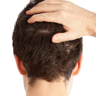 Saç Ekiminden Sonra İlk Hafta