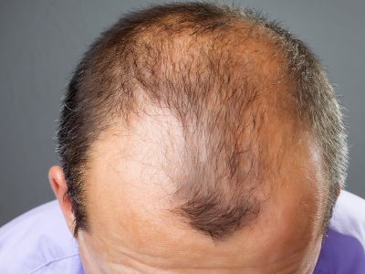 Saç kökü transferi