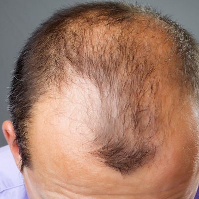 Saç kökü transferi