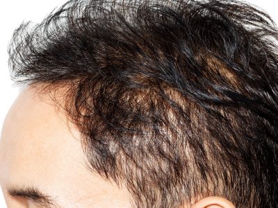 Saç tellerinin incelmesi genetik nedenlerden kaynaklanabilmektedir. 