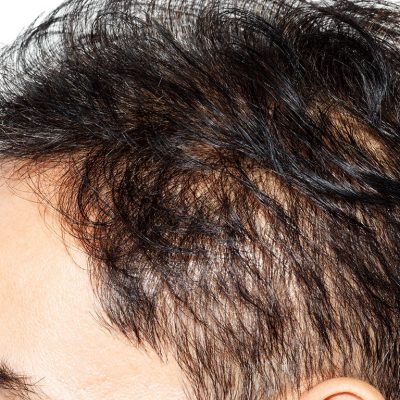 Saç tellerinin incelmesi genetik nedenlerden kaynaklanabilmektedir.