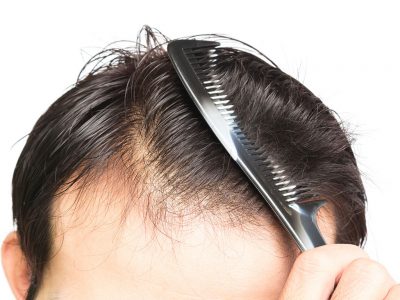 Saç yağlanmasının nedenleri hormonal ve metonbalik nedenler olabilmektedir. 