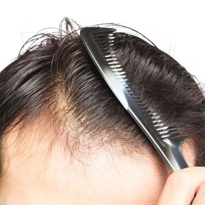 Saç yağlanmasının nedenleri hormonal ve metonbalik nedenler olabilmektedir.