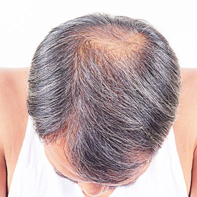 Saçların yaşlanması