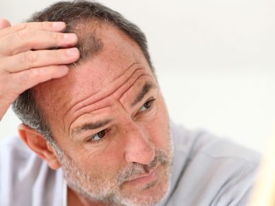 Saçların Zayıflaması, İncelmesi