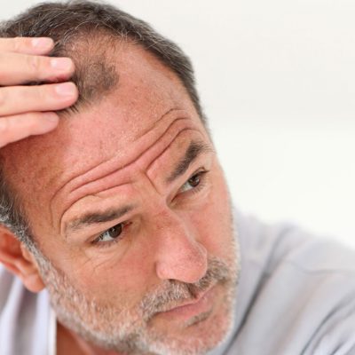 Saçların Zayıflaması, İncelmesi