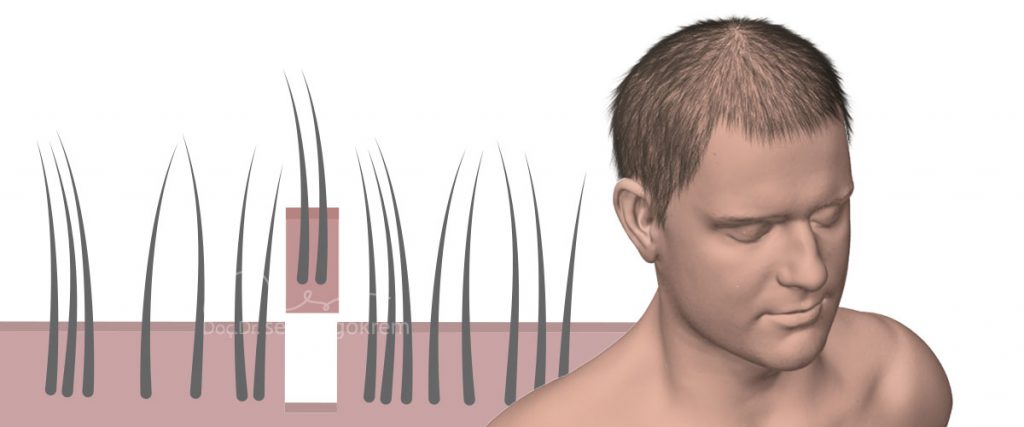 fue saç ekimi uygulanışı